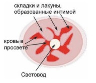 Схематичное изображение вены, «обжатой» раствором анестетика вокруг световода