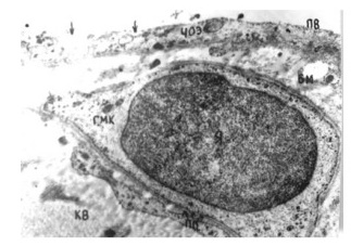 Нарушение целостности плазматической мембраны на люминальной поверхности цитоплазматического отростка эндотелиоцита 