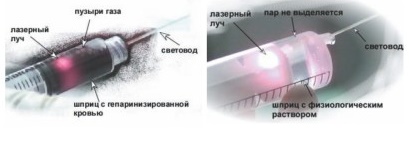 Эндовазальная лазерная коагуляция вен (ЭВЛК, ЭВЛО) в Москве